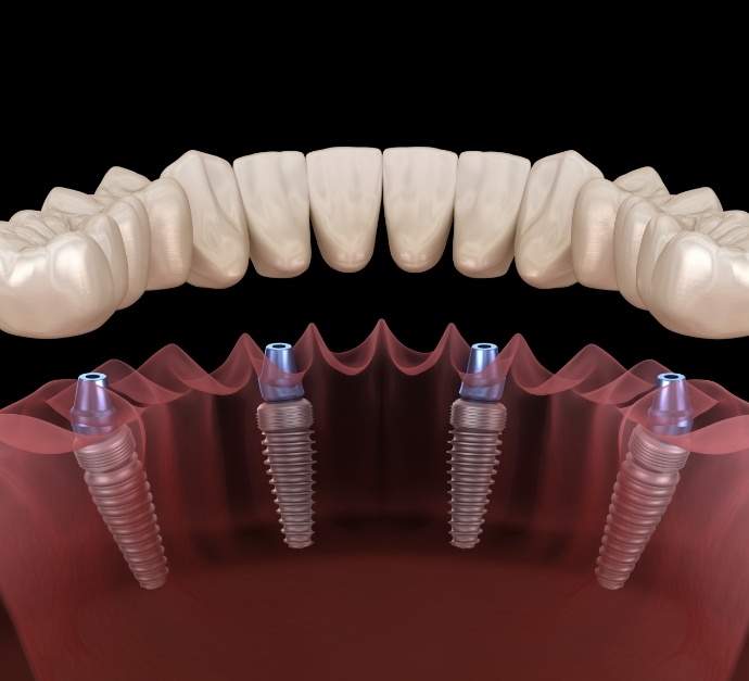 Illustrated All on 4 implant denture being placed on lower arch