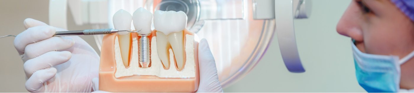 Dentist holding a model of a dental implant