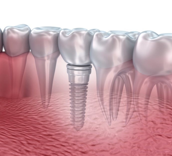 Illustrated dental implant replacing a missing lower tooth