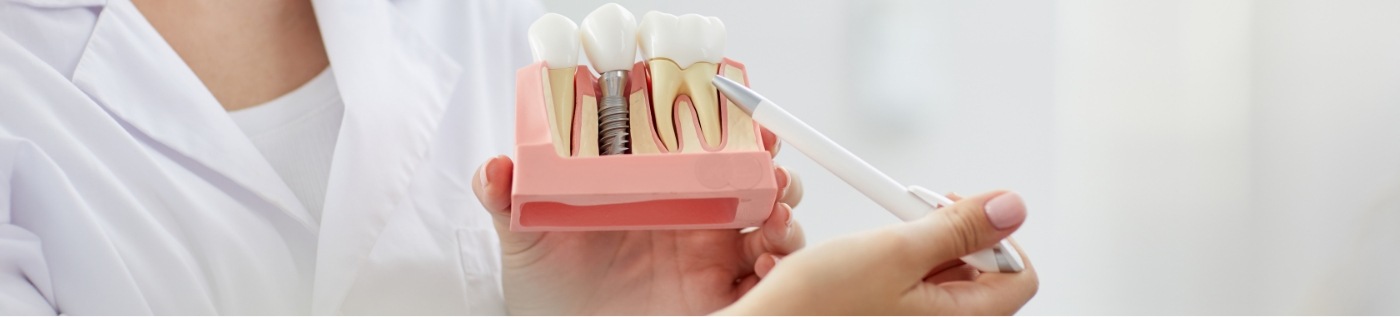 Dentist showing a patient a model of dental implants in Richardson