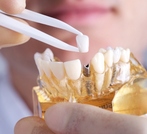 Dentist placing a crown on a dental implant model