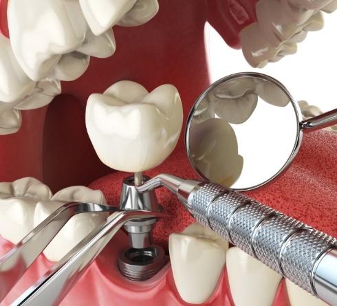 Illustration of dental implant being placed in lower jaw