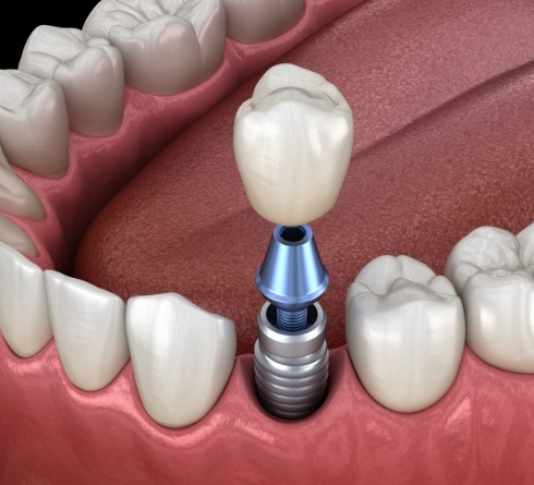 Illustrated dental crown being fitted onto a dental implant