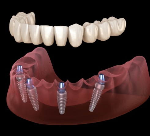 Illustrated full denture being fitted onto four dental implants