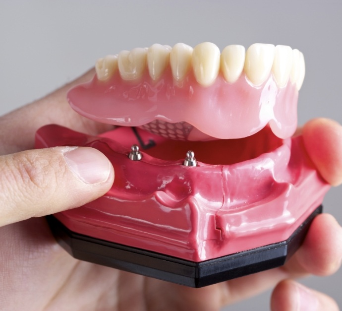 Hand holding a model of an implant denture