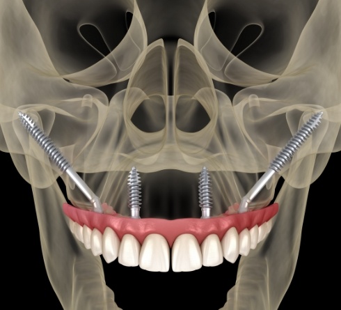 Illustrated x ray of skull with implant denture on upper arch