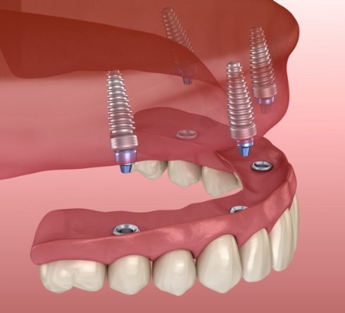 Illustration of implant denture being placed on upper arch