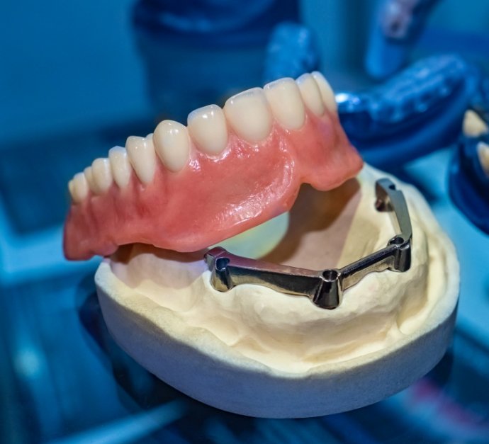 Model of implant denture in dental office