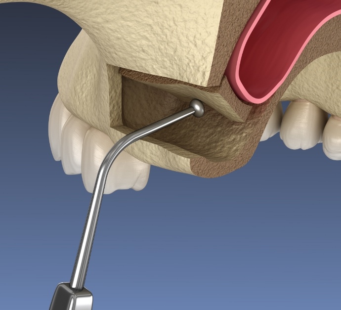 Illustrated dental instrument gently lifting sinus