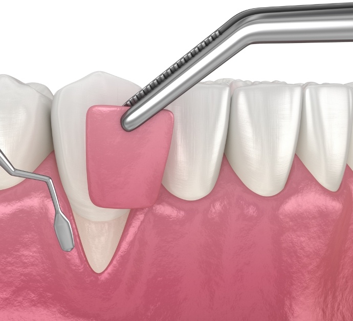 Illustrated gum tissue being grafted in front of a tooth