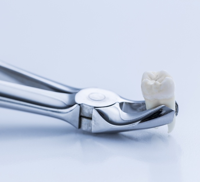 Dental clasps holding an extracted tooth