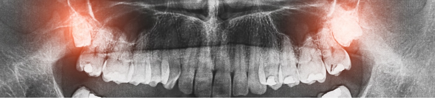 Dental x ray with the wisdom teeth highlighted red