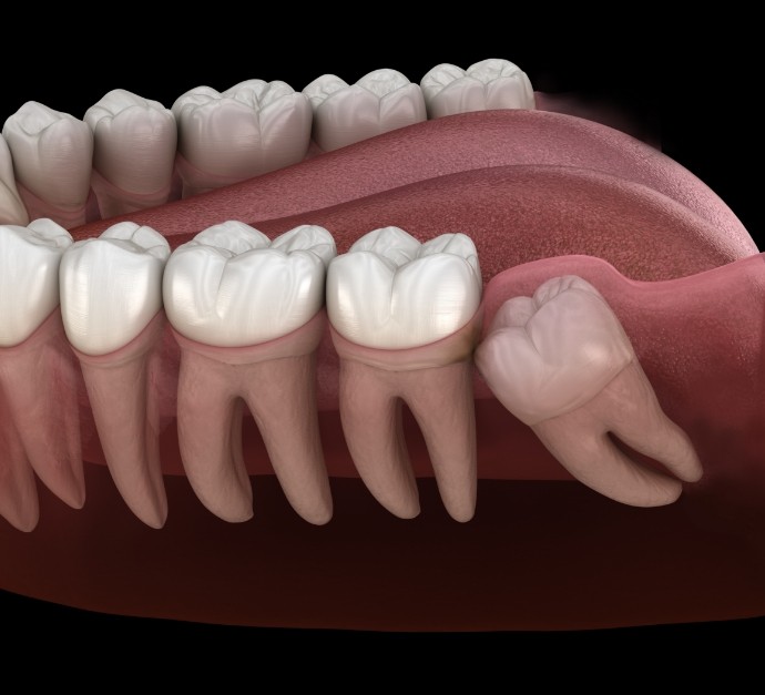 Illustration of impacted wisdom tooth pressing against adjacent molar