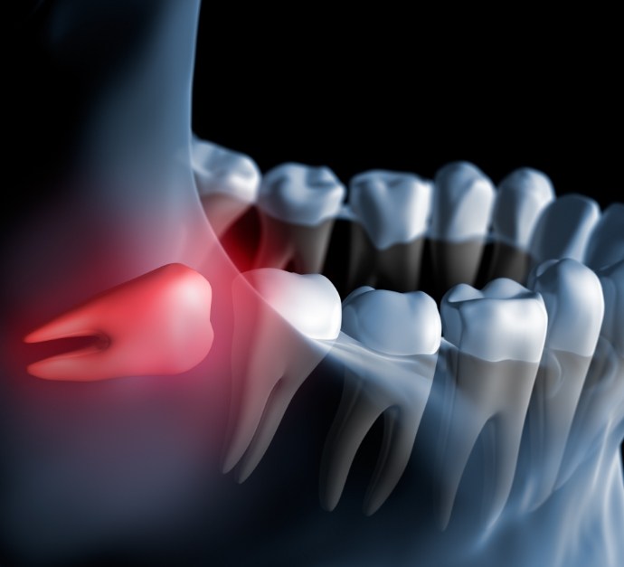 Illustration of impacted wisdom tooth pushing against adjacent tooth