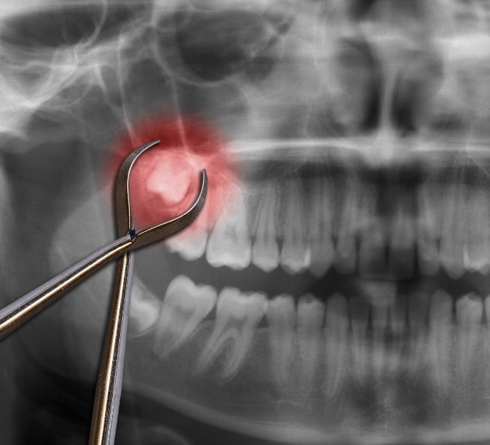 Dental clasps in front of x ray showing impacted wisdom tooth