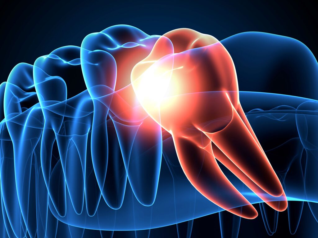 Blue transparent diagram of lower teeth with an orange wisdom tooth growing in crooked